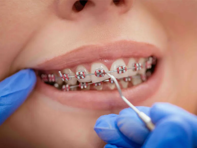 Contention orthodontie par le docteur Jacob orthodontiste à La Rochelle