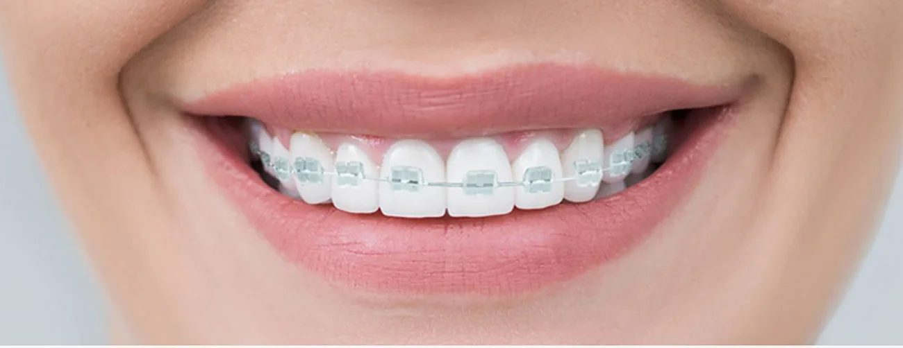 Ne manquez pas vos rendez-vous chez votre orthodontiste. La Réussite du traitement orthodontique en dépend.