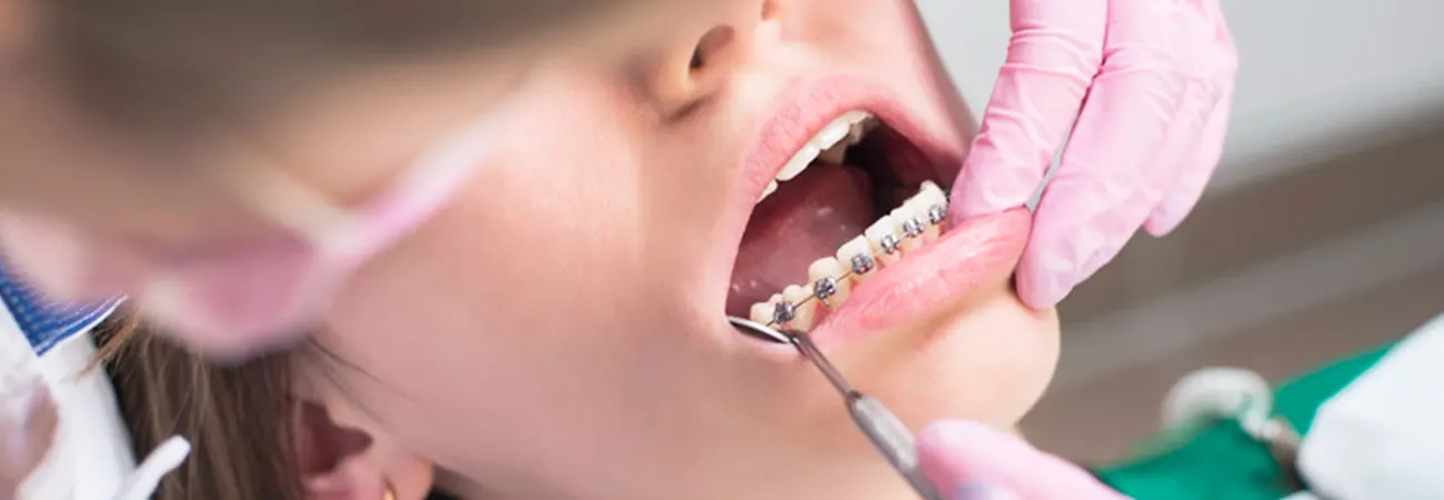 Orthodontie, comment éviter de casser son appareil, par le docteur Jacob, orthodontiste à La Rochelle