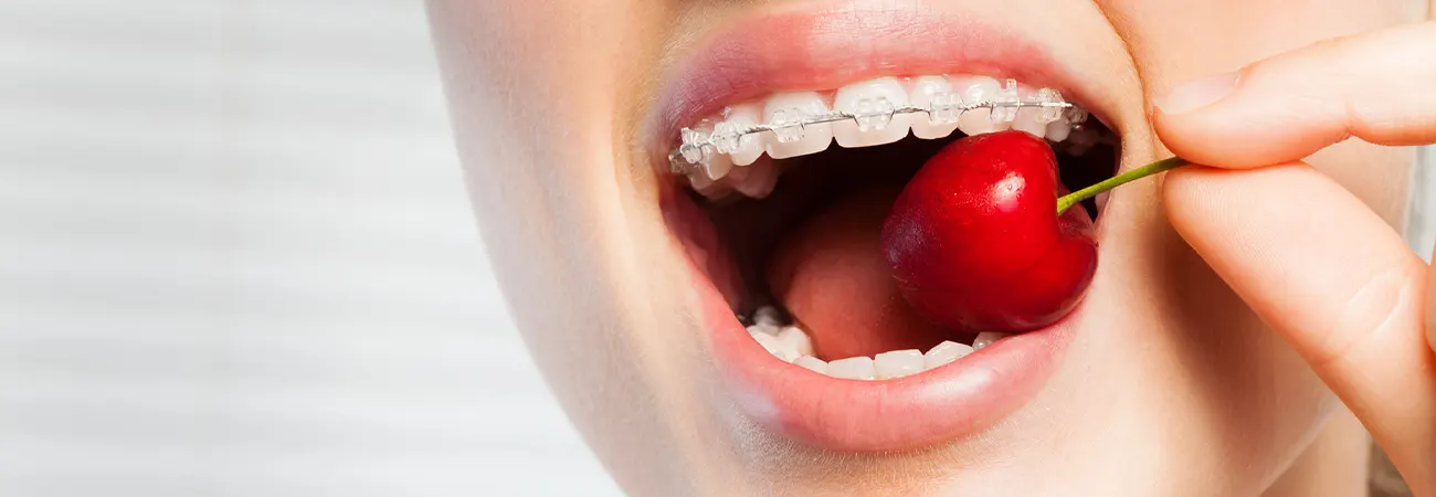 Les conseils d'Olivier Jacob orthodontiste à La Rochelle pour bien vivre avec un appareil dentaire